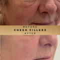 Cheek Fillers Wilmslow
