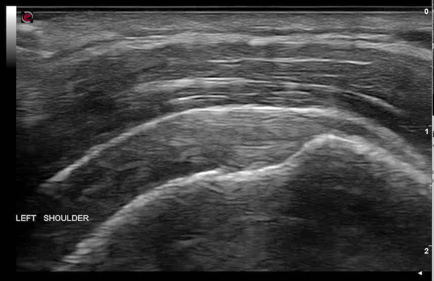 Shoulder Injuries