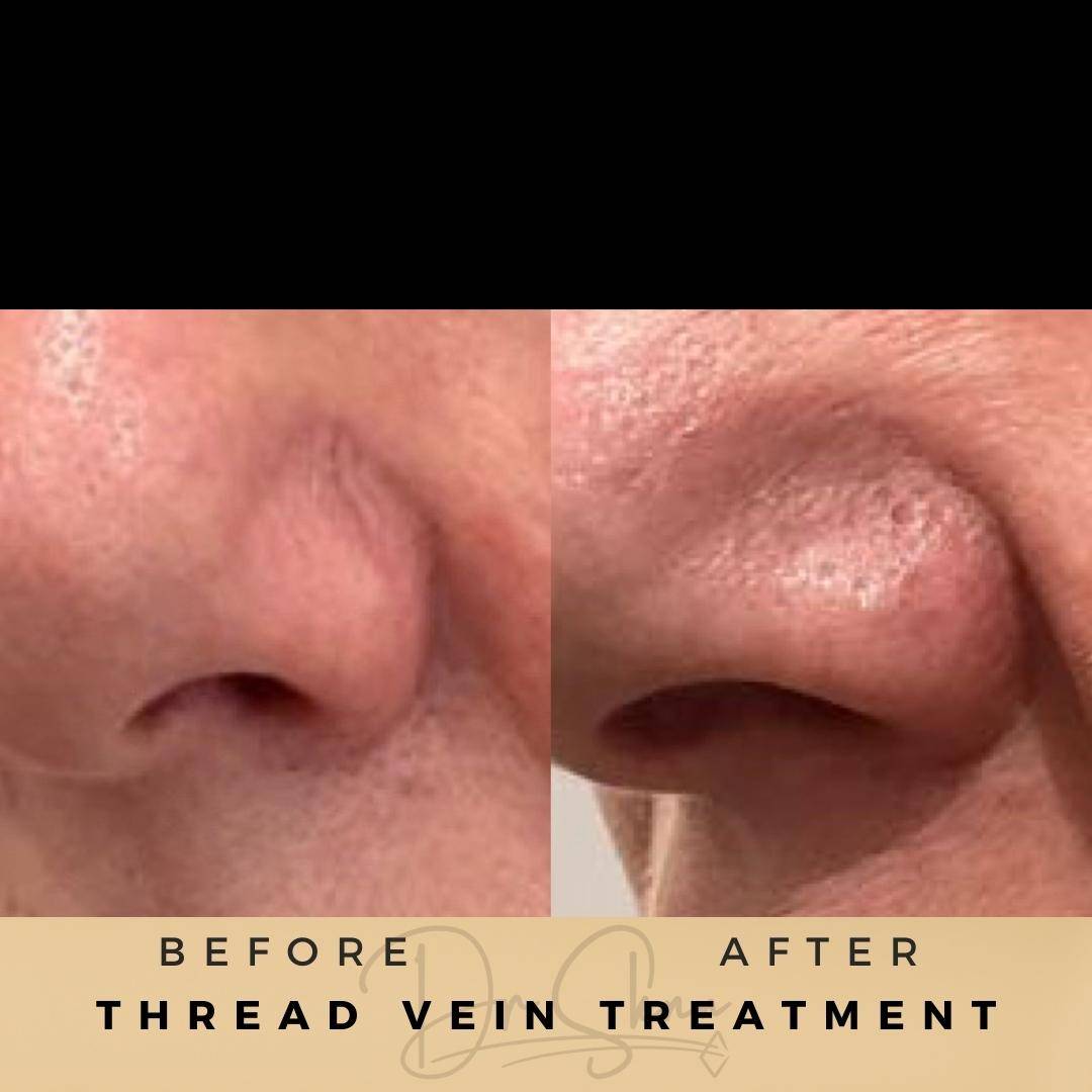 Vascular Treatment Thread Vein Treatment Wilmslow Before & After Dr Sknn