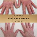 Before & After Pictures Dr Sknn Wilmslow Cheshire