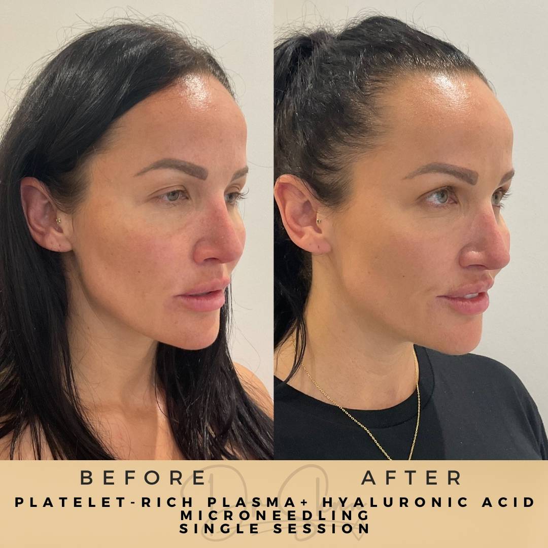 PRP Microneedling - Dr Sknn before and after
