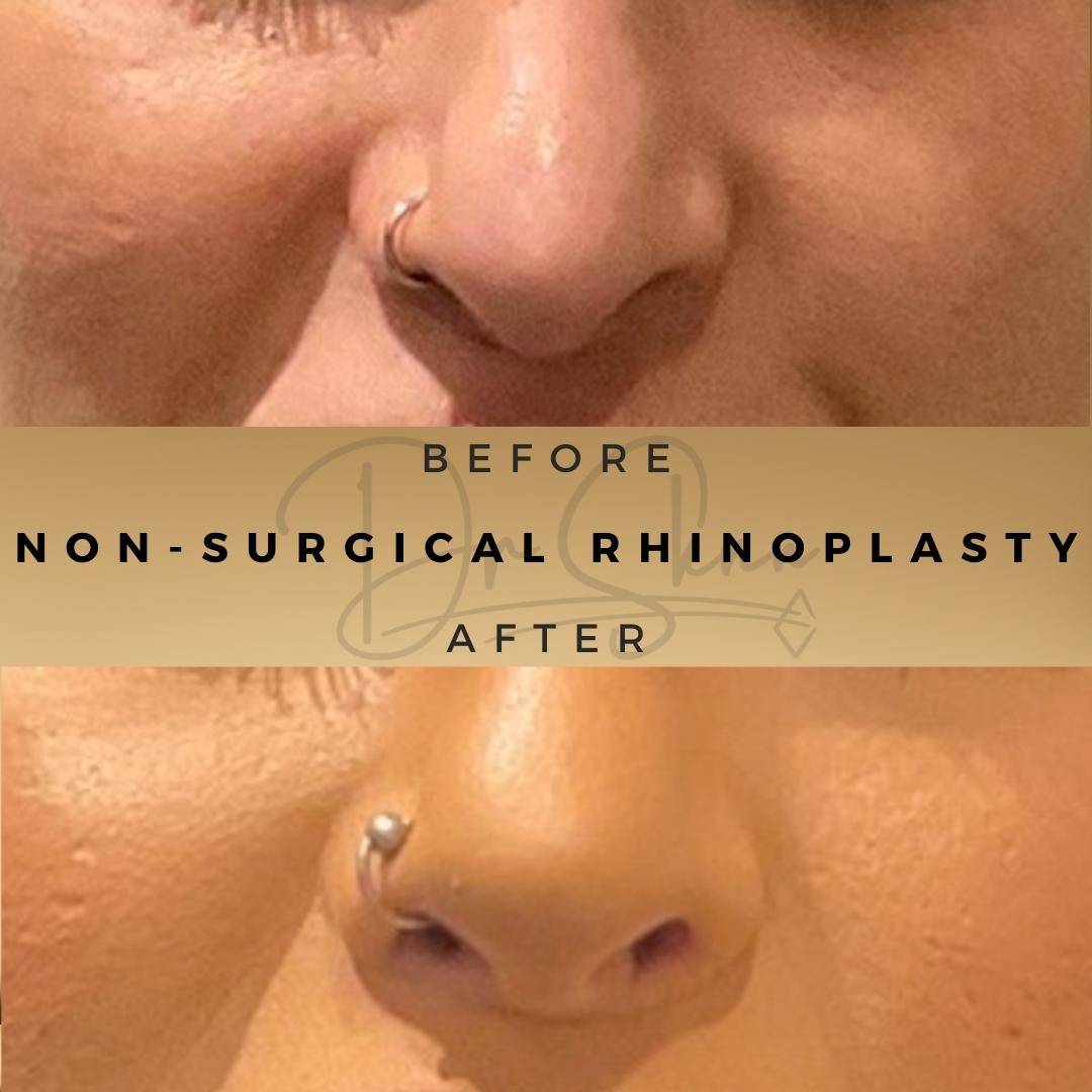 Non-surgical Rhinoplasty