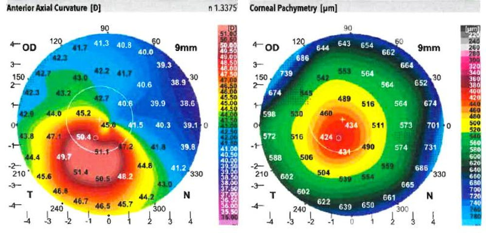 Cornea maps for stage 2 of keratoconus