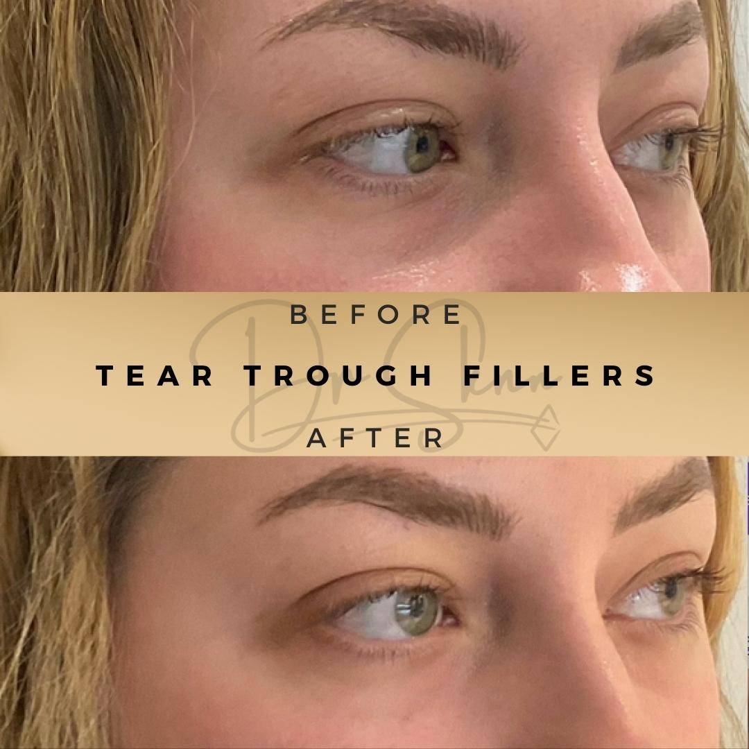 Tear Trough Fillers - Dr Sknn before and after