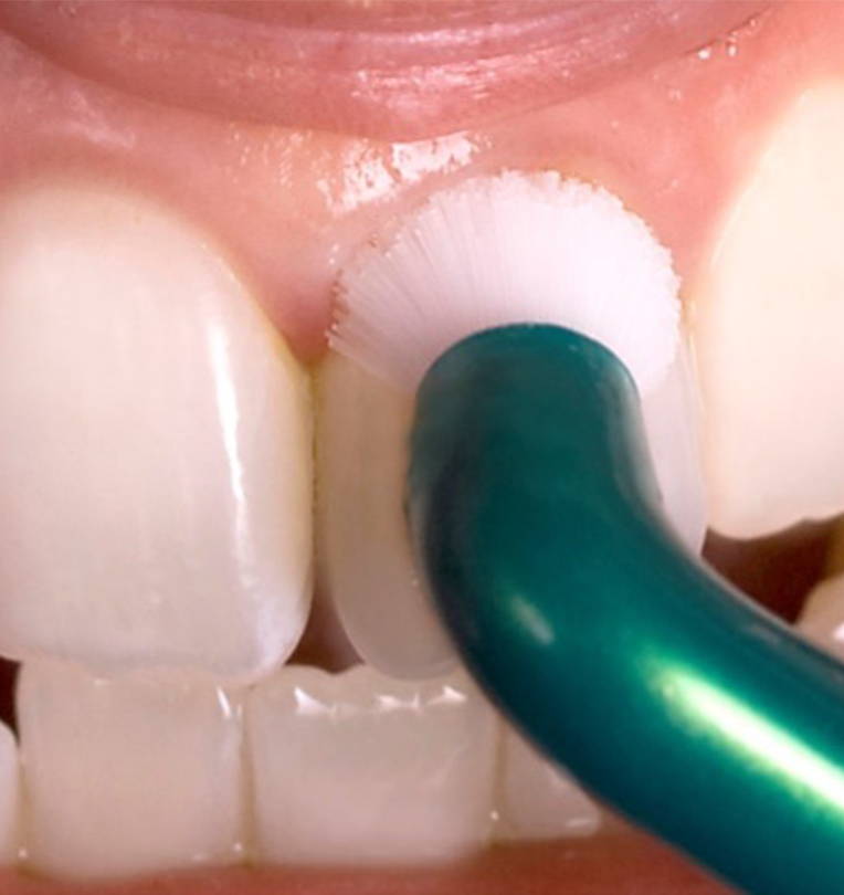 Oral Hygiene The Foundation Of Aesthetic Dentistry Clinical 