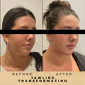 Jaw Fillers Wilmslow Before & After Dr Sknn