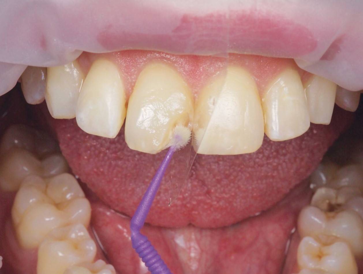 Open mouth with purple tool applying product to upper tooth