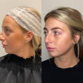 Non-Surgical Face Lift and Neck Lift Dr Sknn Before and After 1