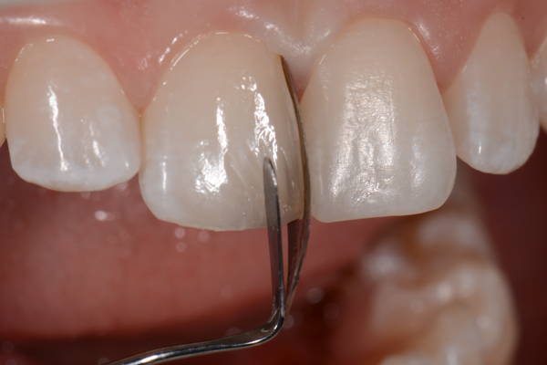 composite instrument shaping composite into tooth