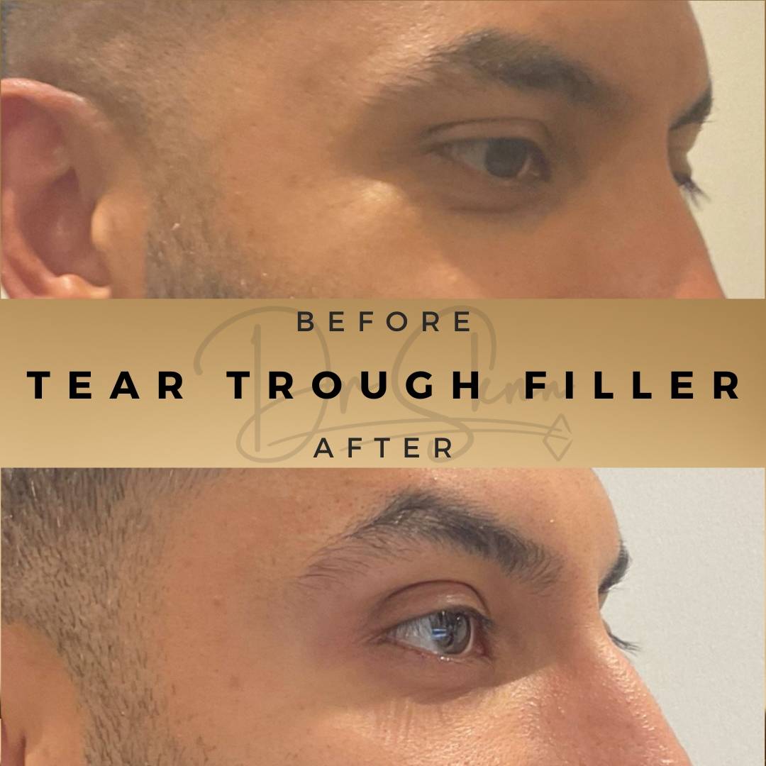 Tear Trough Fillers Wilmslow Before & After Dr Sknn