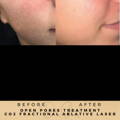 Open Pores Treatment Co2 Fractional Laser Wilmslow Dr Sknn Before & After Picture