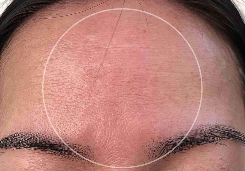 marine-collagen-before-after-pictures-wrinkles