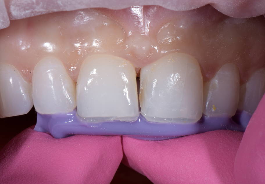 Teeth with thin layer of composite biting into purple matrix material