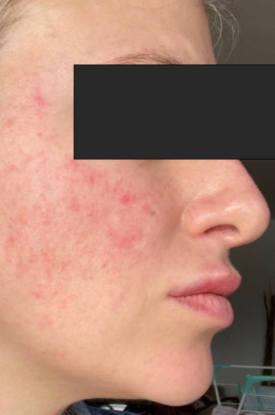 Female face with rosacea before using Natural Elements Sincare