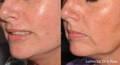 Womans cheek before and after Lumecca IPL 
