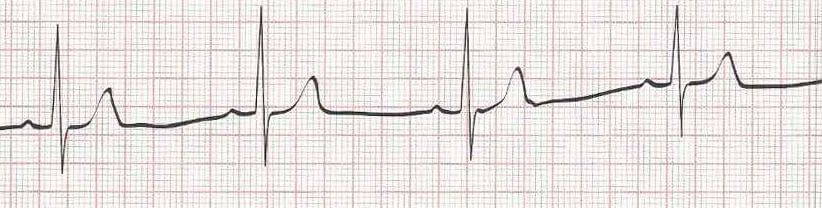 Sinus Brady — heart rate is less than 60