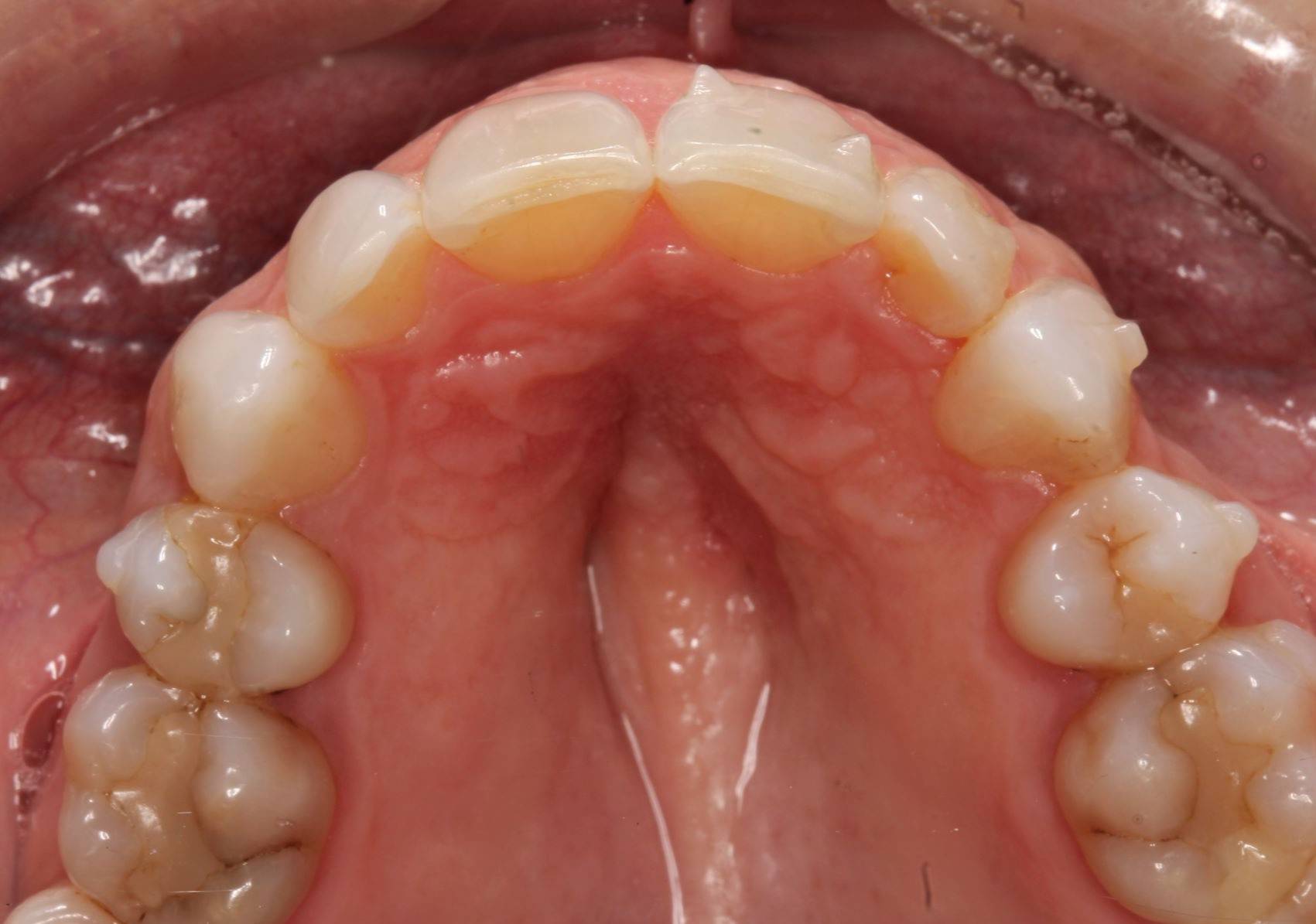 Pre-operative maxillary occlusal view 