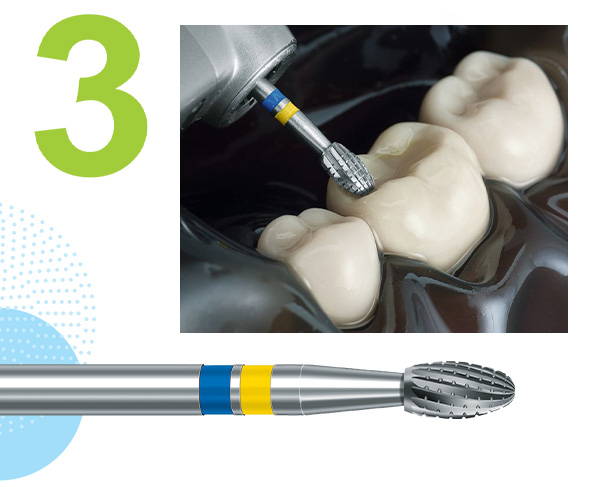 Komet® H379Q Tungsten Carbide Palatal/Occlusal Q-Finisher® Bur and its clinical application on a plastic teeth model