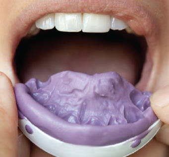 Impression tray with set purple material being removed from patient's mouth