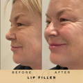 Perioral Line Fillers Wilmslow Before & After
