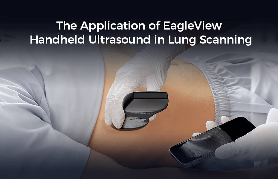 The Application of EagleView Handheld Ultrasound in Lung Scanning