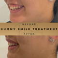 Gummy Smile Correction Fillers Before & After