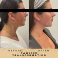 Jaw Fillers Wilmslow Before & After Dr Sknn