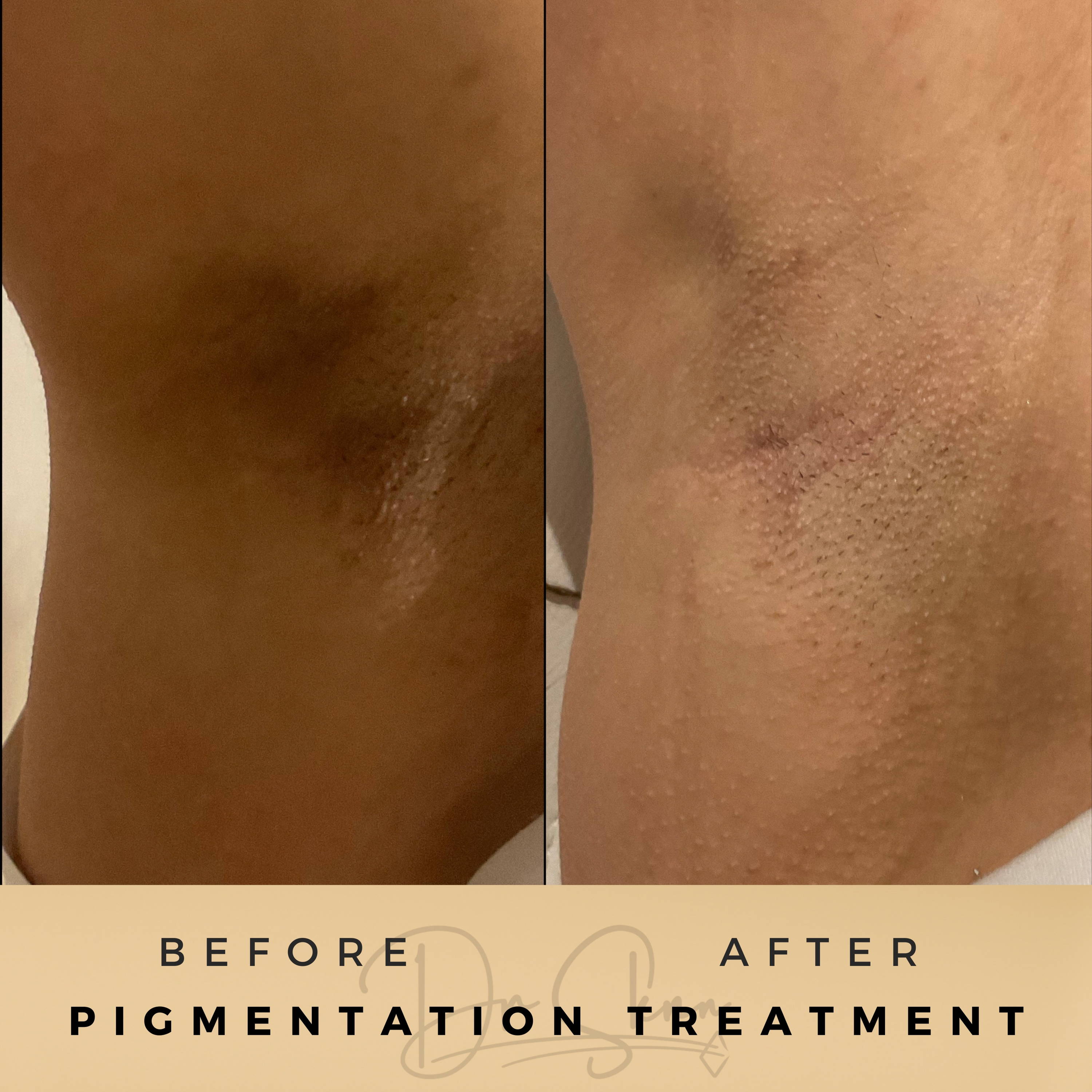 Pigmentation Treatment Wilmslow Before & After Dr Sknn