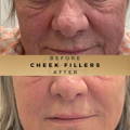 Cheek Fillers Wilmslow