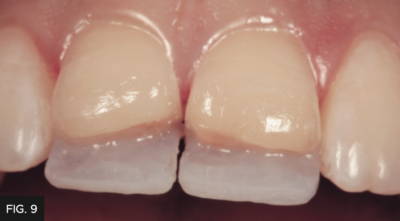 FX Enamel White layer placed on both central incisors