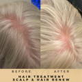 Hair Loss Treatment Dr Sknn Before & After Picture