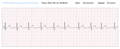 Typische abnormale EKGs