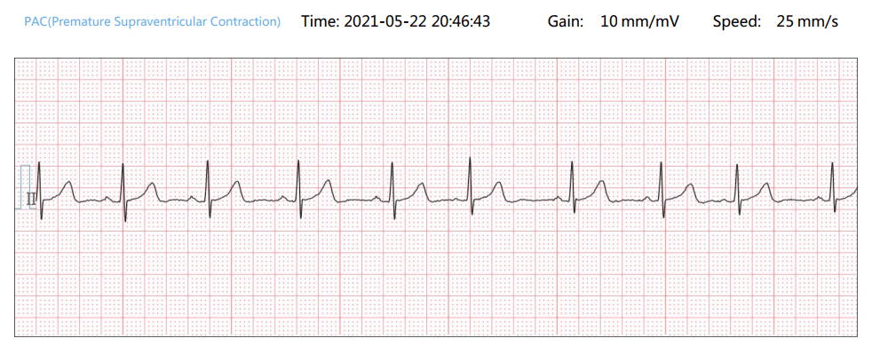 ECG anormales típicos