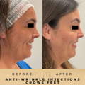 Smile Lines Anti-Wrinkle Injections Wilmslow