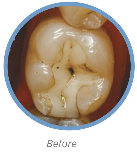 Posterior tooth prior to restoration