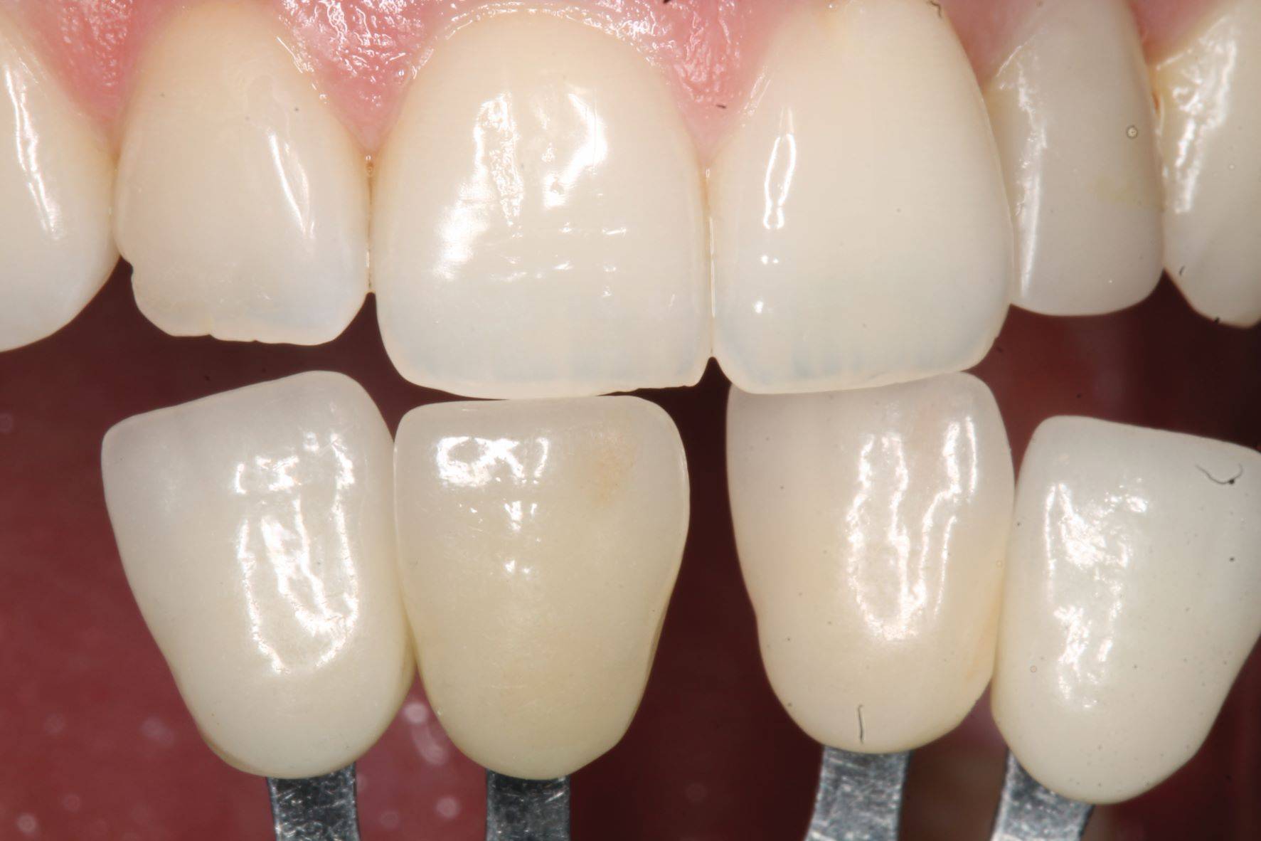 Teeth along with teeth samples to evaluate shading