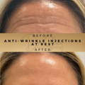 Before & After Pictures Dr Sknn Wilmslow Cheshire