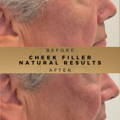 Cheek Fillers Wilmslow