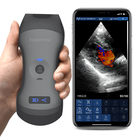 EagleView portable ultrasound compare with other ultrasound scanners