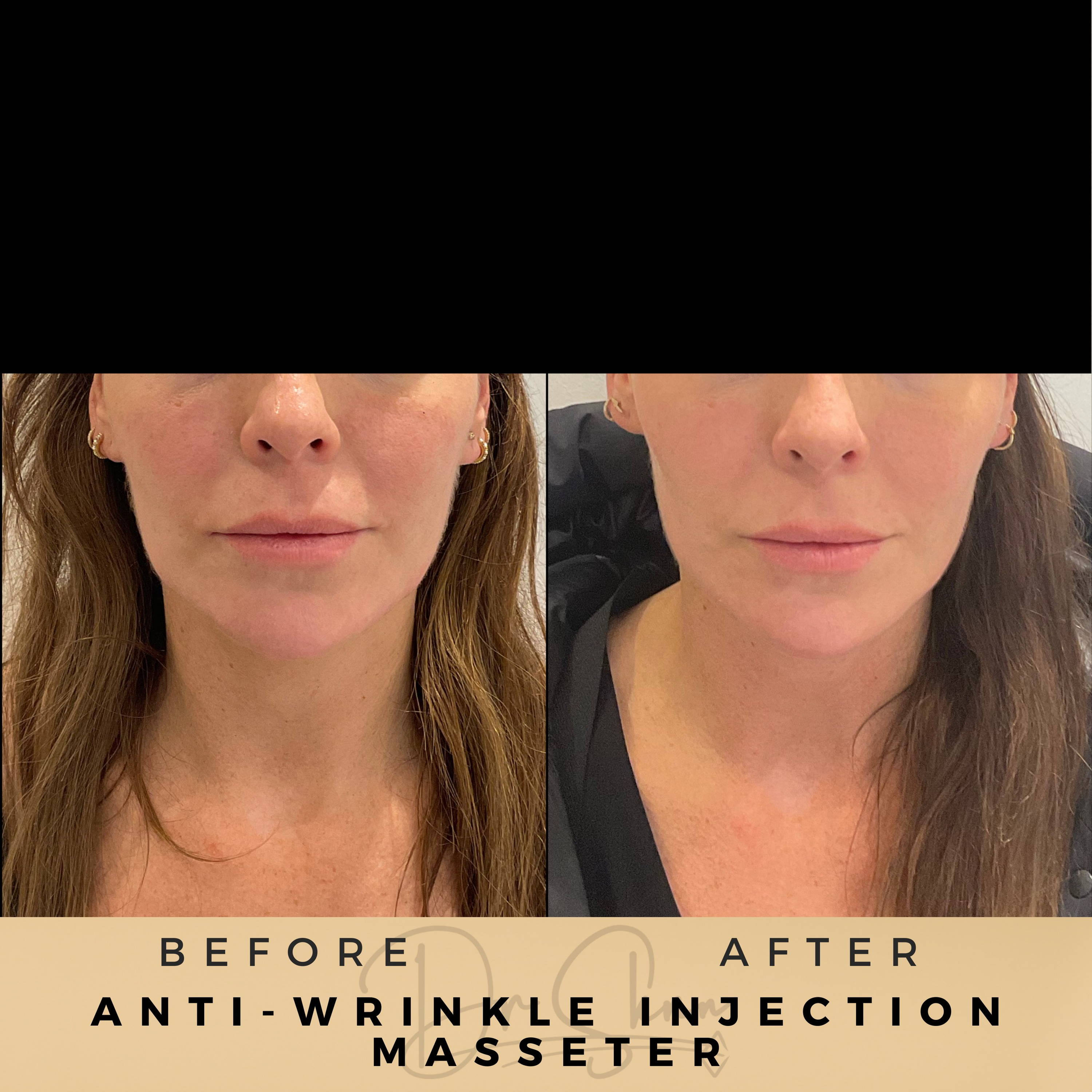 TMJ Treatment Anti-Wrinkle Injections Wilmslow Before & After Dr Sknn