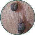 dark skin tag