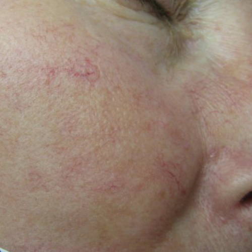 Intense Pulsed Light Vascular lesions After