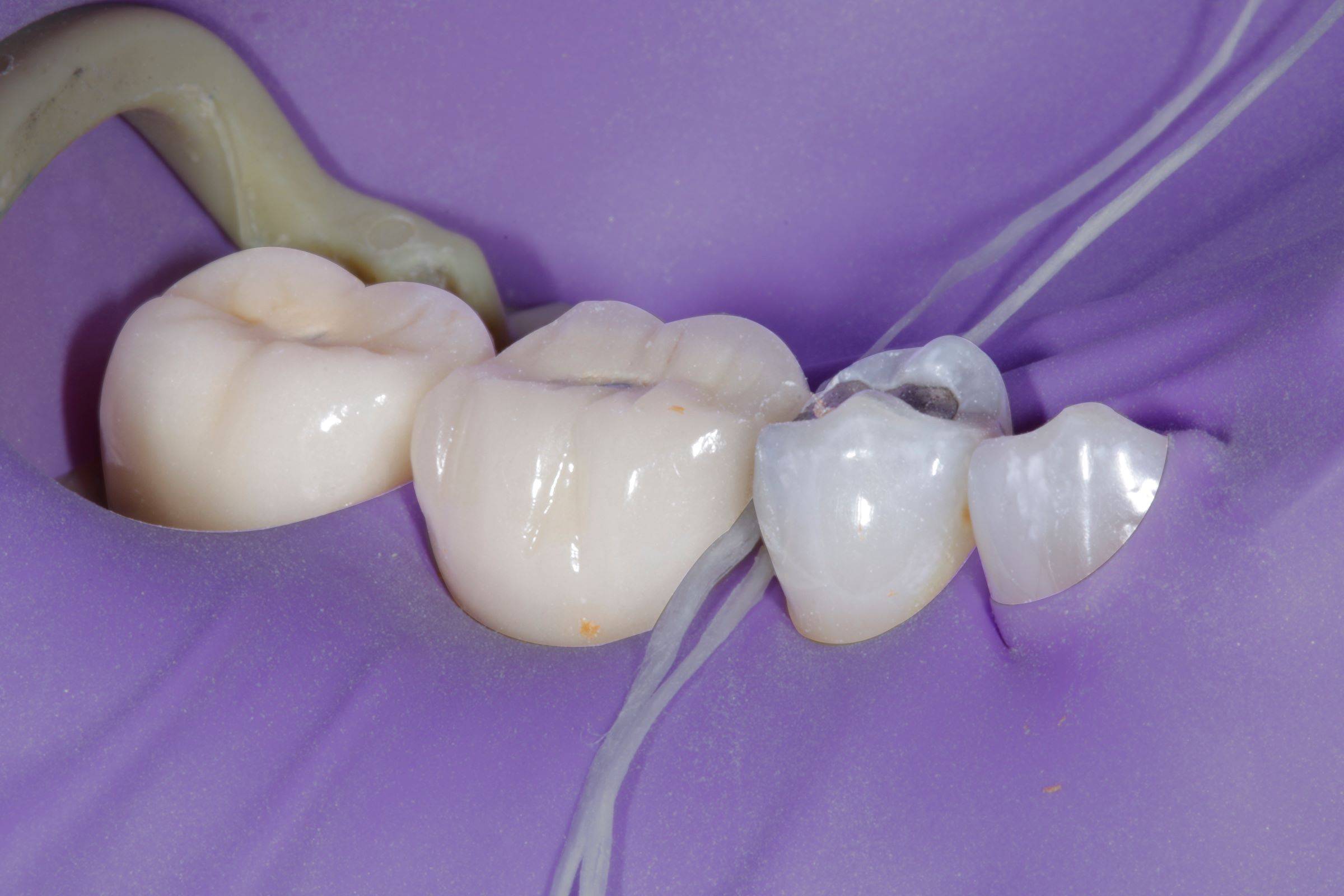 Teeth isolated with purple rubber dam