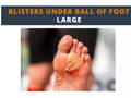 Blisters under ball of foot