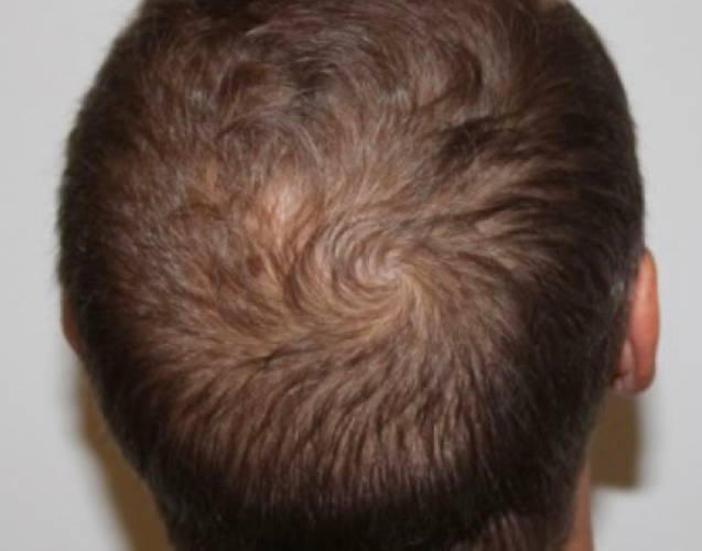 Dr Sknn Hair Restoration After