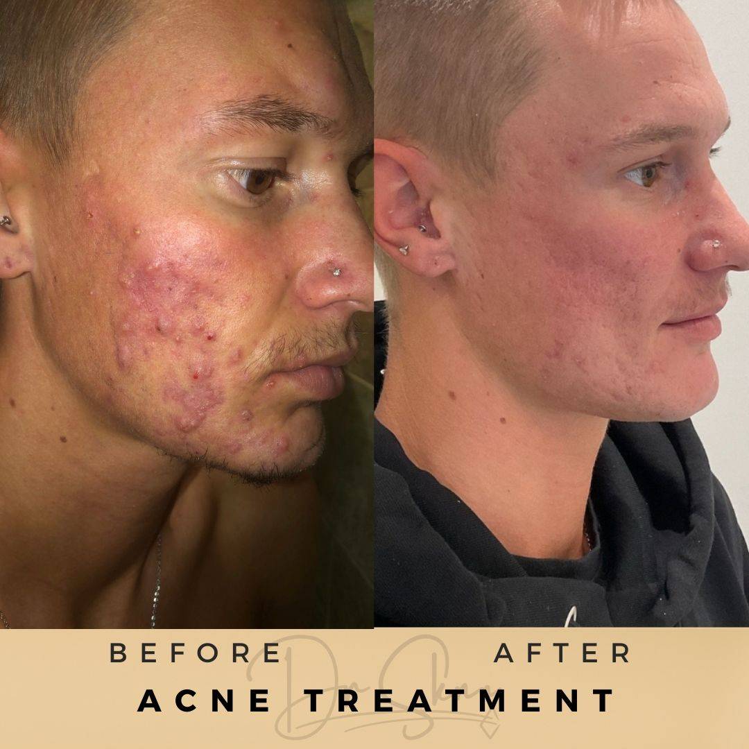 Acne Treatment Wilmslow Before & After Dr Sknn