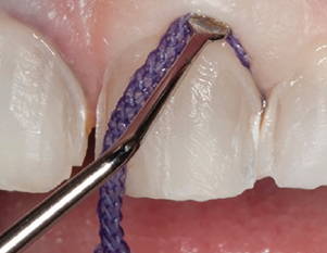 purple retraction cord being placed