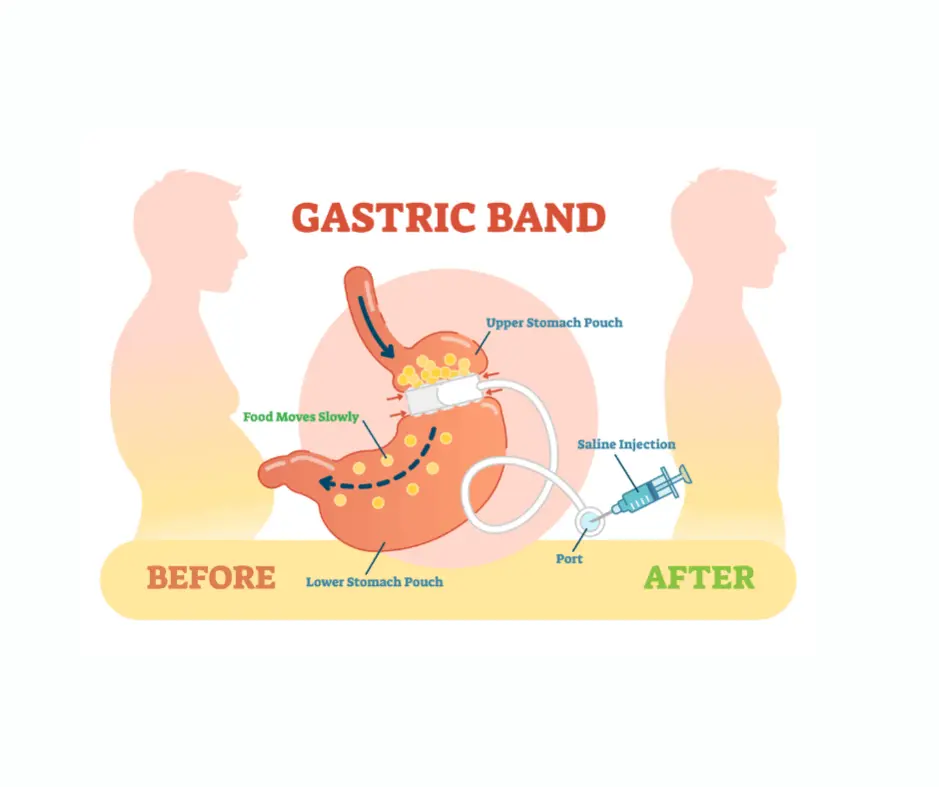 Gastric Band Bariatric Surgery & Weight loss in dubai