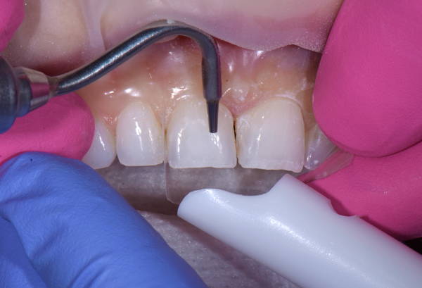 Air-abrasion system removing upper teeth debris