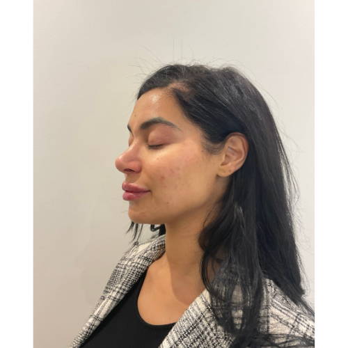 Dr Sknn Lip Fillers After